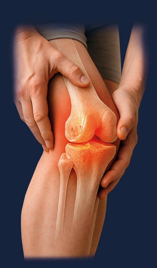 Simulação de osteoartrite no joelho